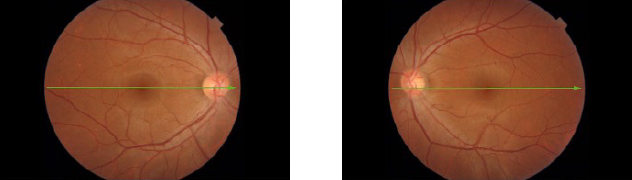 一般的な人間ドックの眼底写真